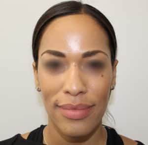 Real patient Rhinoplasty by Dr.Somenek, Washington D.C.