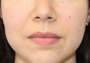 Real patient Buccal Fat Removal by Dr.Somenek, Washington D.C.