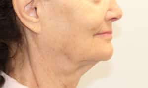 Real Patient SomenekMD Signature Lift, Somenek + Pittman MD, Washington D.C.