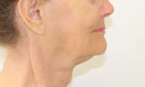 Real Patient SomenekMD Signature Lift, Somenek + Pittman MD, Washington D.C.