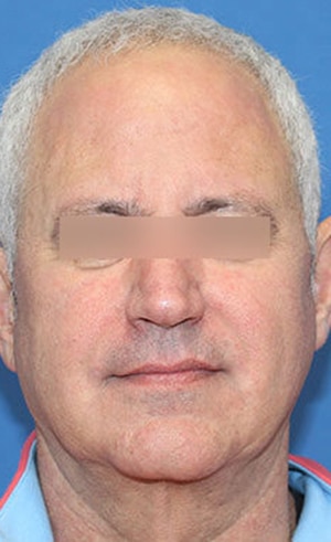 Real patient Facelift by Dr.Somenek, Washington D.C.