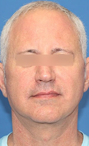 Real patient Facelift by Dr.Somenek, Washington D.C.