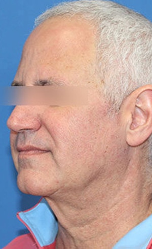 Real patient Facelift by Dr.Somenek, Washington D.C.