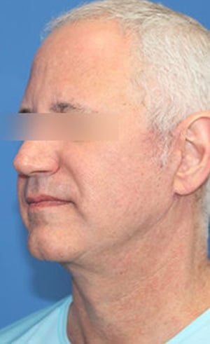 Real patient Facelift by Dr.Somenek, Washington D.C.