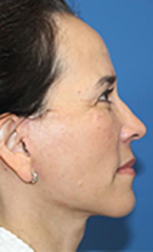 Real patient Facelift by Dr.Somenek, Washington D.C.