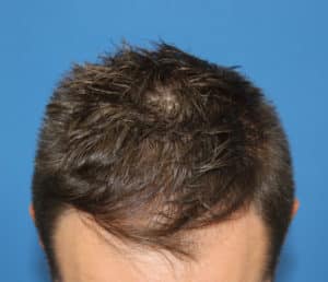 Real patient Hair Restoration, Somenek + Pittman MD, Washington D.C.