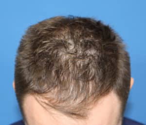Real patient Hair Restoration, Somenek + Pittman MD, Washington D.C.