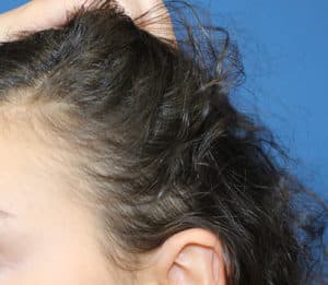 Real patient Hair Restoration, Somenek + Pittman MD, Washington D.C.
