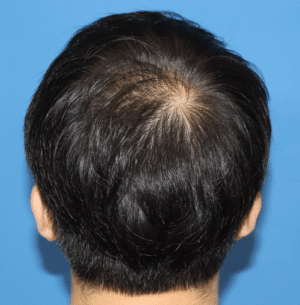 Real patient Hair Restoration, Somenek + Pittman MD, Washington D.C.