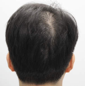 Real patient Hair Restoration, Somenek + Pittman MD, Washington D.C.