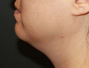 Real Patient Kybella, Somenek + Pittman MD, Washington D.C.