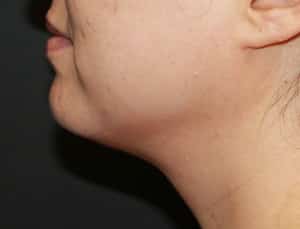 Real Patient Kybella, Somenek + Pittman MD, Washington D.C.