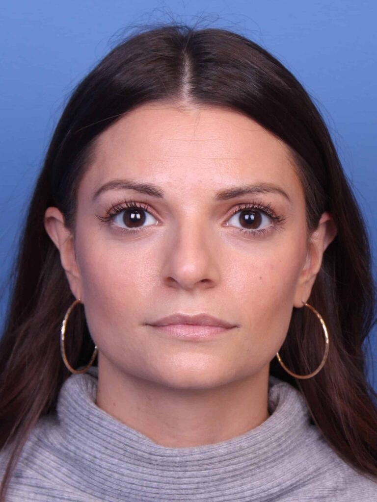Real patient Rhinoplasty by Dr.Somenek, Washington D.C.