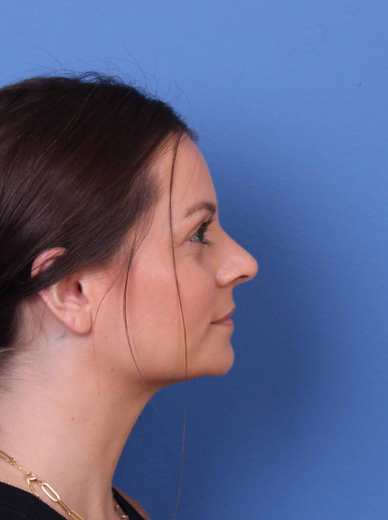 Real patient Rhinoplasty by Dr.Somenek, Washington D.C.