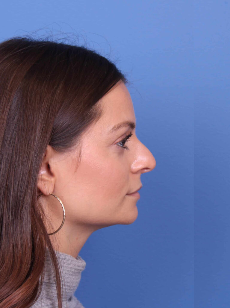 Real patient Rhinoplasty by Dr.Somenek, Washington D.C.