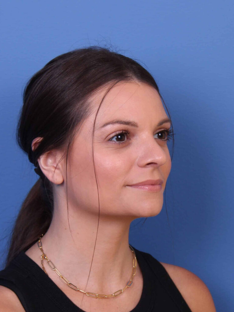 Real patient Rhinoplasty by Dr.Somenek, Washington D.C.