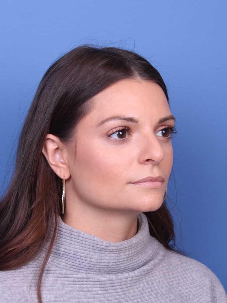 Real patient Rhinoplasty by Dr.Somenek, Washington D.C.