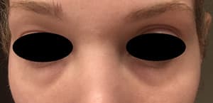 Real patient Filler, Somenek + Pittman MD, Washington D.C.