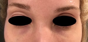 Real patient Filler, Somenek + Pittman MD, Washington D.C.