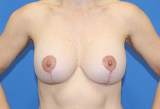 Real patient Mastopexy with Breast Augmentation by Dr.Pittman, Washington D.C.
