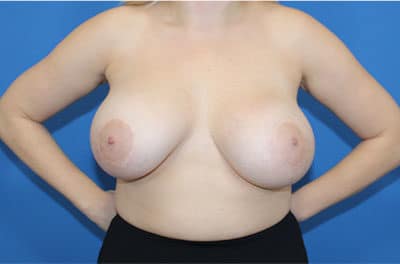 Real patient Revision Mastopexy Breast Lift and Breast Augmetnation by Dr.Pittman, Washington D.C.