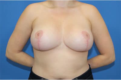 Real patient Revision Mastopexy Breast Lift and Breast Augmetnation by Dr.Pittman, Washington D.C.