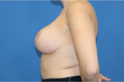 Real patient Revision Mastopexy Breast Lift and Breast Augmetnation by Dr.Pittman, Washington D.C.