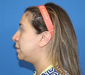 Real Patient SomenekMD Signature Lift, Somenek + Pittman MD, Washington D.C.