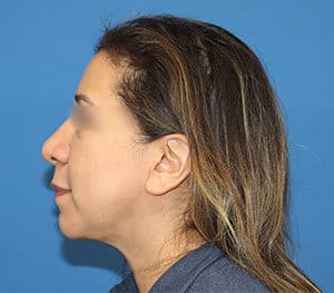 Real Patient SomenekMD Signature Lift, Somenek + Pittman MD, Washington D.C.