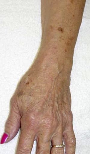 Real Patient Hand Rejuvenation, Somenek + Pittman MD, Washington D.C.
