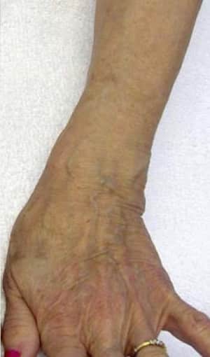 Real Patient Hand Rejuvenation, Somenek + Pittman MD, Washington D.C.