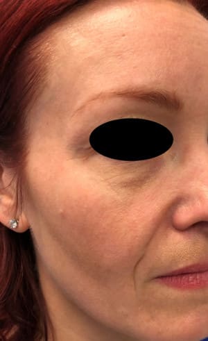 Real patient Filler, Somenek + Pittman MD, Washington D.C.