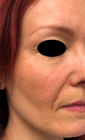 Real patient Filler, Somenek + Pittman MD, Washington D.C.