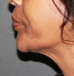 Real patient Facetite, Somenek + Pittman MD, Washington D.C.