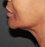 Real patient Facetite, Somenek + Pittman MD, Washington D.C.