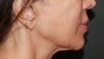 Real patient Facetite, Somenek + Pittman MD, Washington D.C.