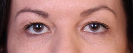 Real patient Blepharoplasty by Dr.Pittman, Washington D.C.