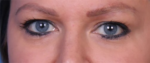 Real patient Blepharoplasty by Dr.Pittman, Washington D.C.