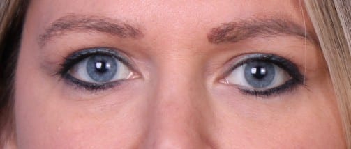 Real patient Blepharoplasty by Dr.Pittman, Washington D.C.