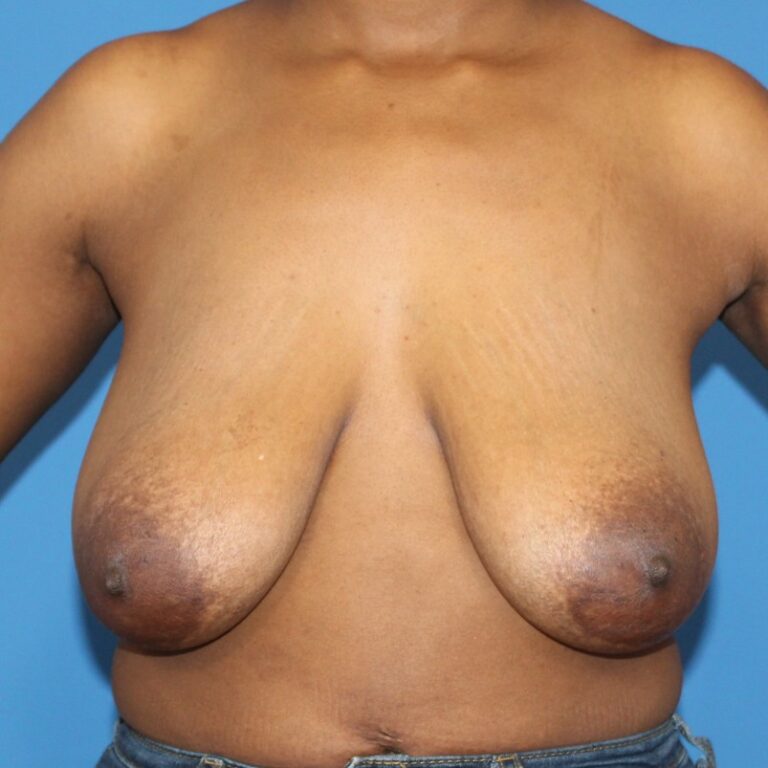 Real patient Mastopexy Breast Lift by Dr.Pittman, Washington D.C.