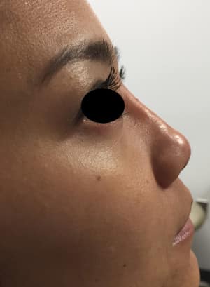 Real Patient Non-Surgical Rhinoplasty, Somenek + Pittman MD, Washington D.C.