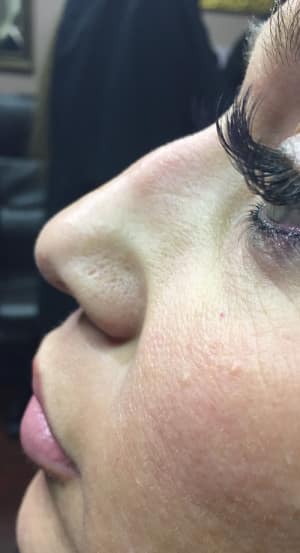 Real Patient SomenekMD Signature Lift, Somenek + Pittman MD, Washington D.C.