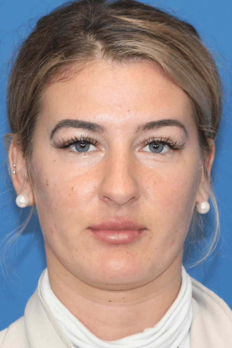 Real patient Rhinoplasty by Dr.Somenek, Washington D.C.