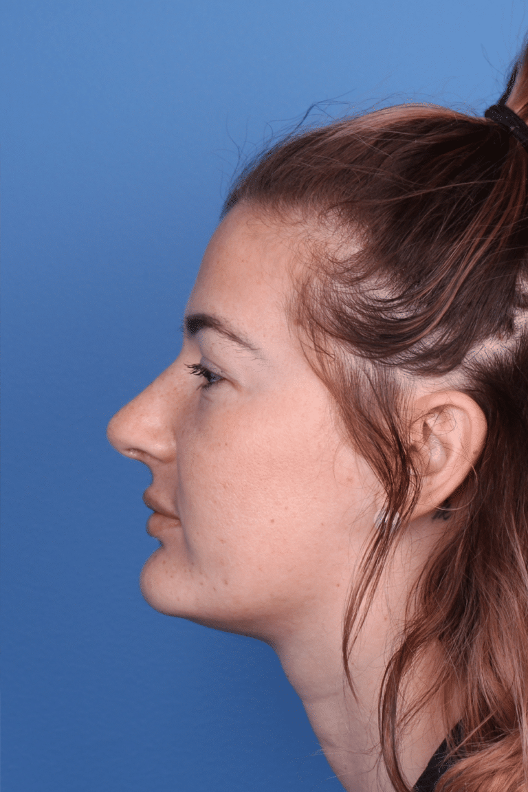 Real patient Rhinoplasty by Dr.Somenek, Washington D.C.