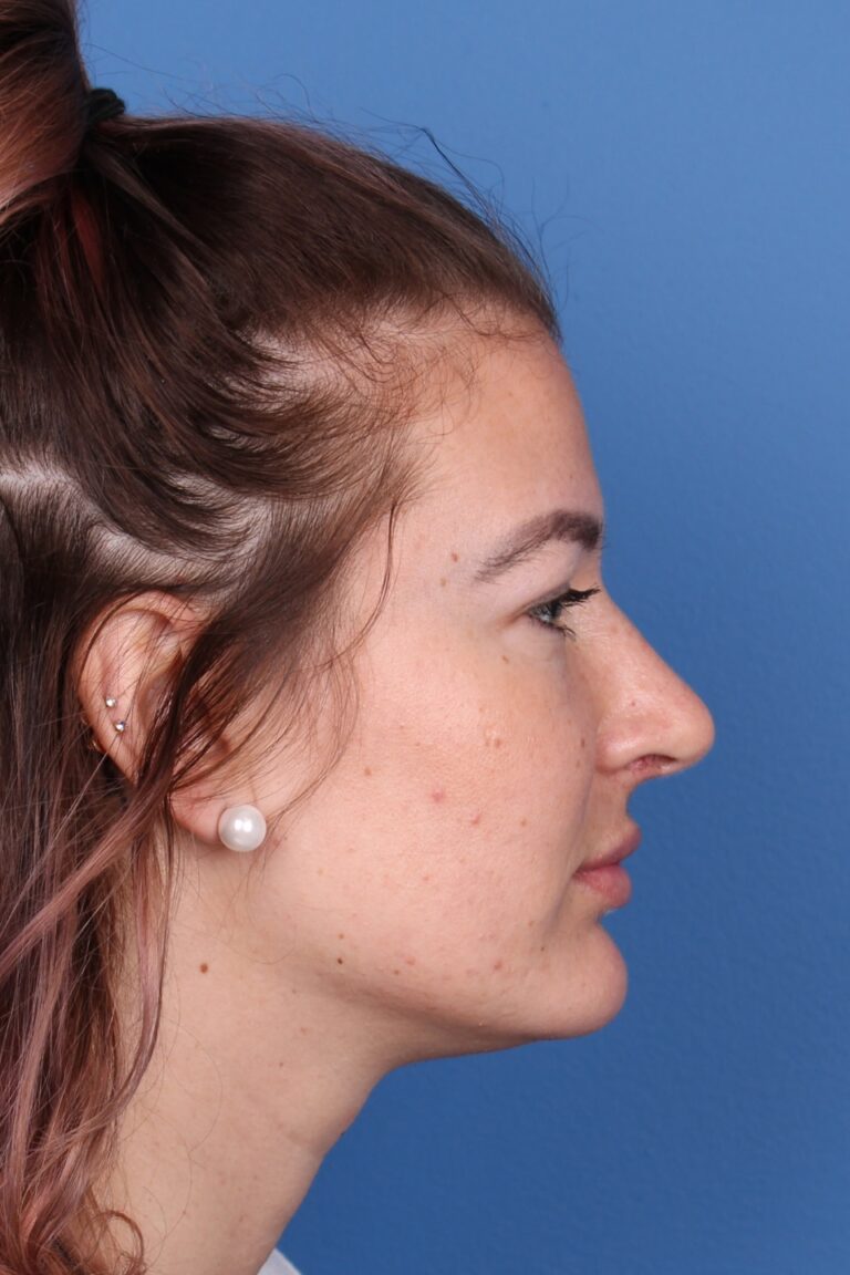 Real patient Rhinoplasty by Dr.Somenek, Washington D.C.
