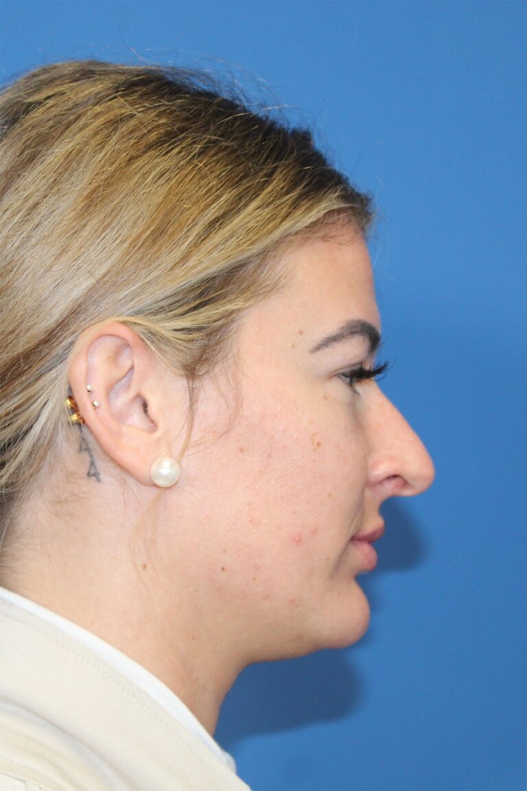 Real patient Rhinoplasty by Dr.Somenek, Washington D.C.
