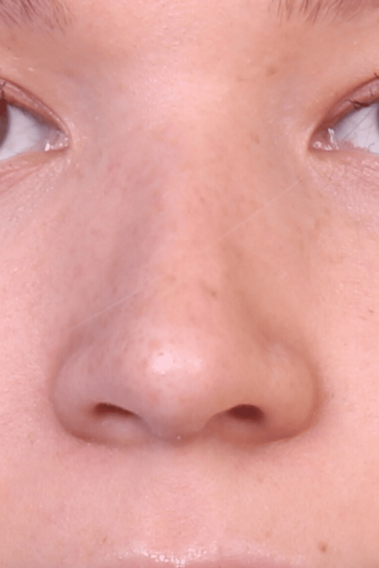 Real patient Rhinoplasty by Dr.Somenek, Washington D.C.
