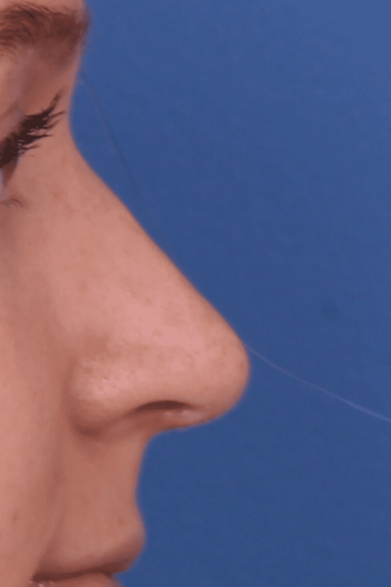 Real patient Rhinoplasty by Dr.Somenek, Washington D.C.