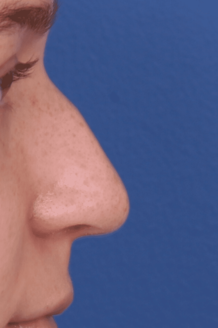 Real patient Rhinoplasty by Dr.Somenek, Washington D.C.