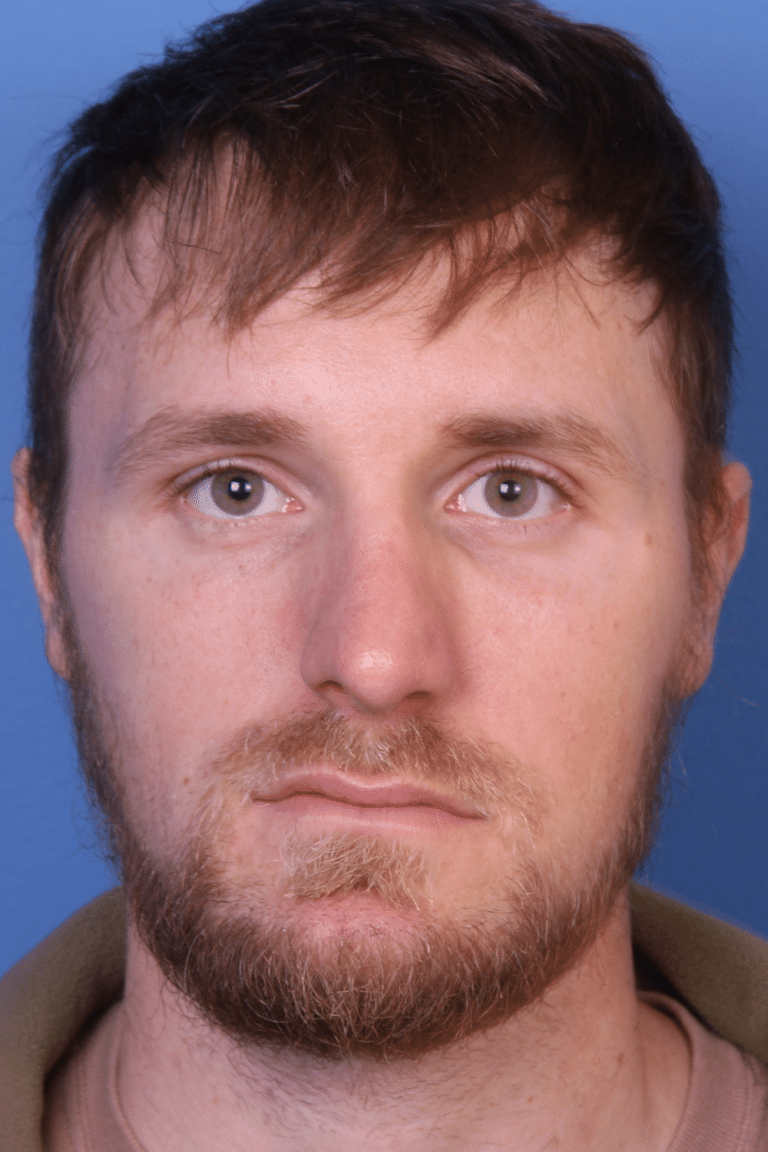 Real patient Rhinoplasty by Dr.Somenek, Washington D.C.